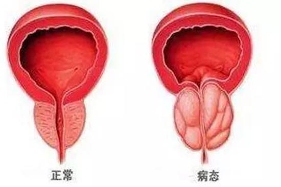 前列腺炎癥能否自愈，解析、理解與應對，前列腺炎癥能否自愈，解析、應對及理解指南