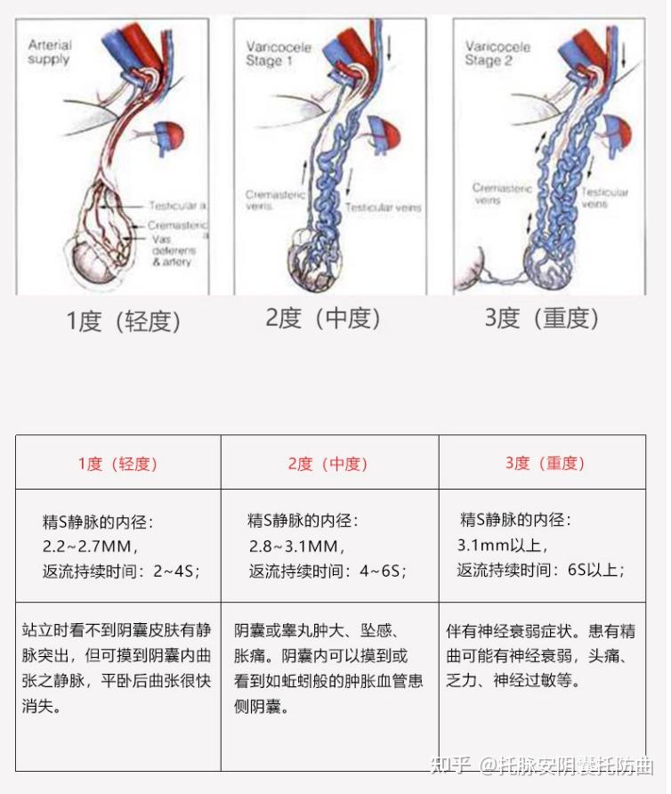 精索靜脈曲張三個程度圖詳解，精索靜脈曲張三個程度詳解圖解