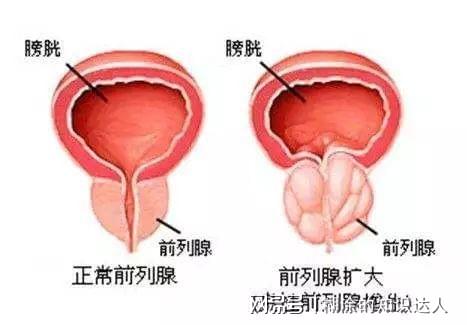 前列腺肥大最佳治療效果探討，前列腺肥大最佳治療方案的探討與研究