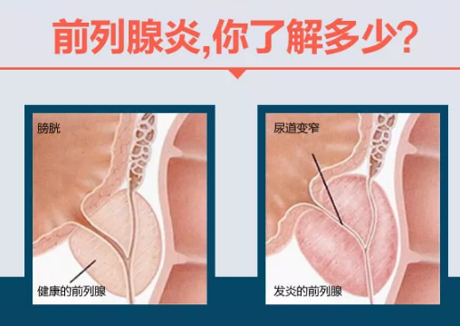 前列腺炎的治愈可能性，理解與探索，前列腺炎的治愈可能性，深入理解與探索