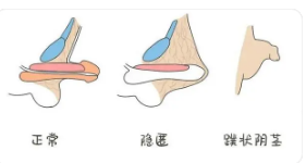 正規(guī)包莖手術(shù)費(fèi)用詳解，正規(guī)包莖手術(shù)費(fèi)用全面解析