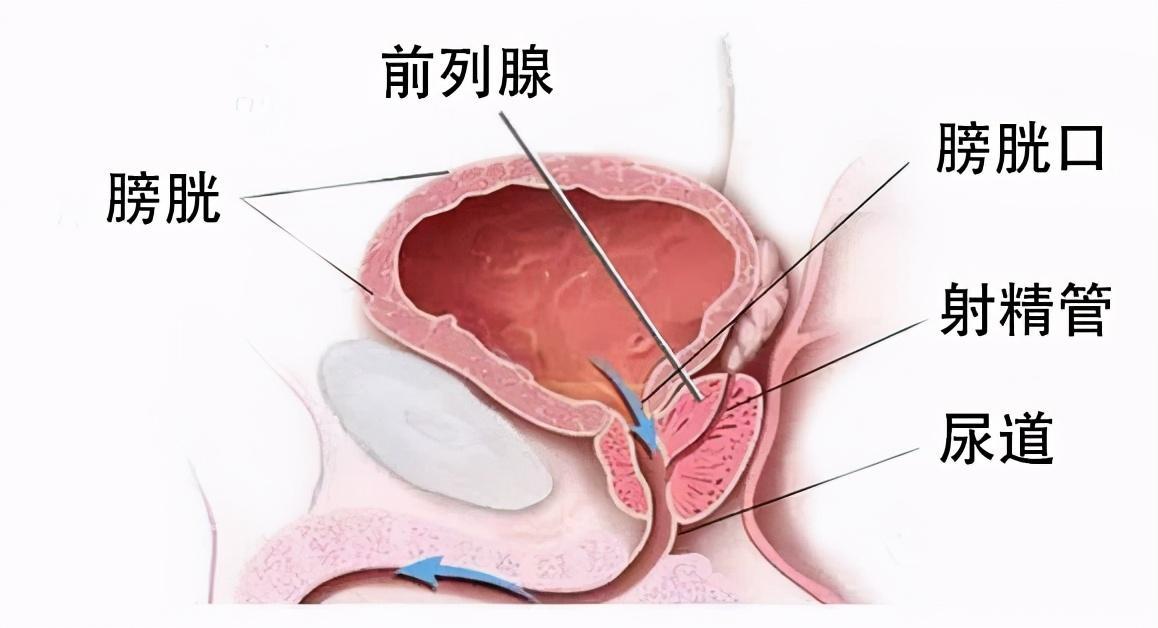 前列腺炎治療周期詳解，前列腺炎治療周期全面解析