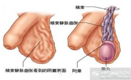 精索靜脈曲張可以自愈嗎？解析與探討，精索靜脈曲張能否自愈？解析與探討