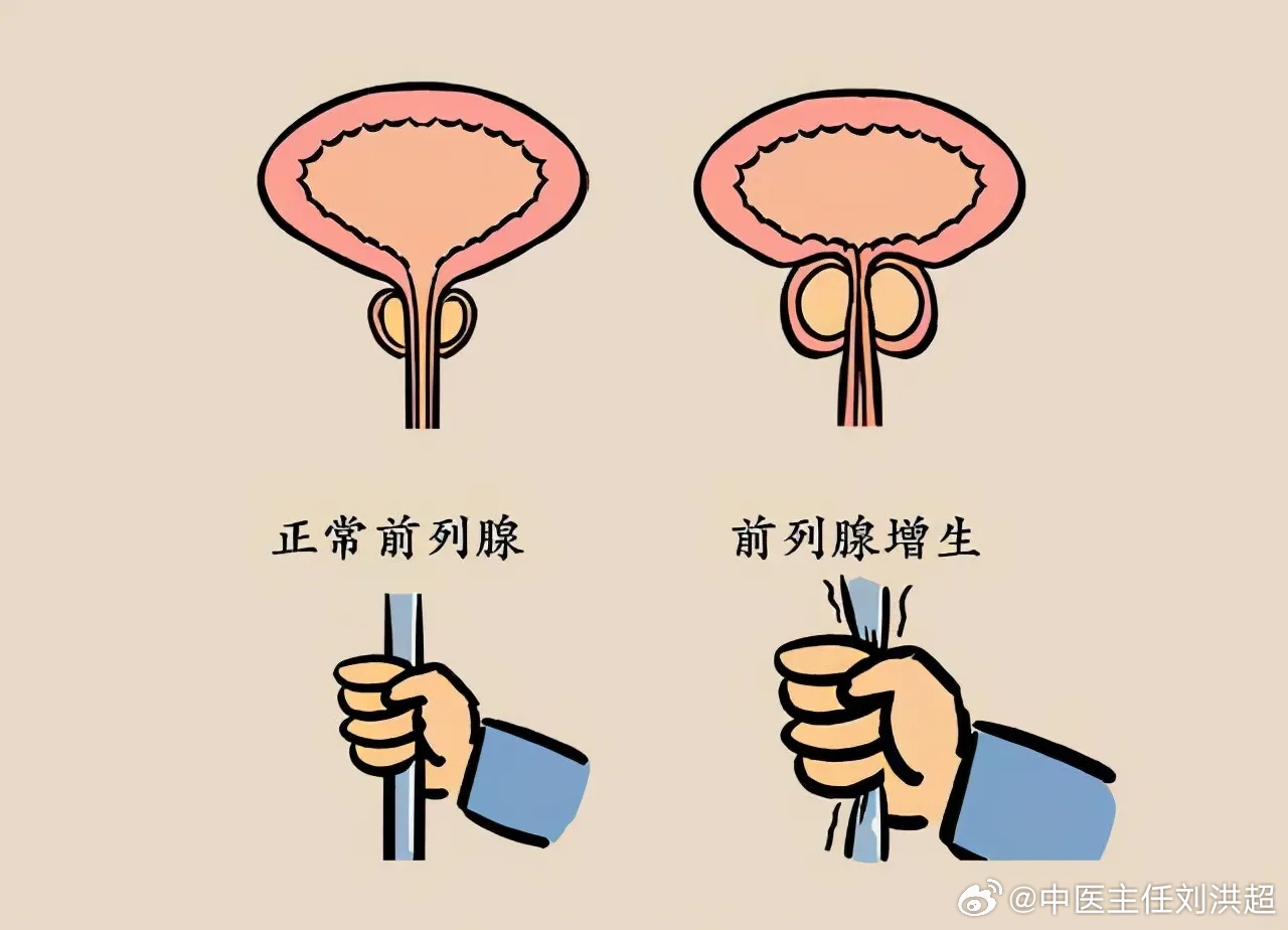 前列腺結(jié)石與性功能障礙，是否存在關(guān)聯(lián)？，前列腺結(jié)石與性功能障礙的關(guān)聯(lián)探討，是否存在潛在聯(lián)系？