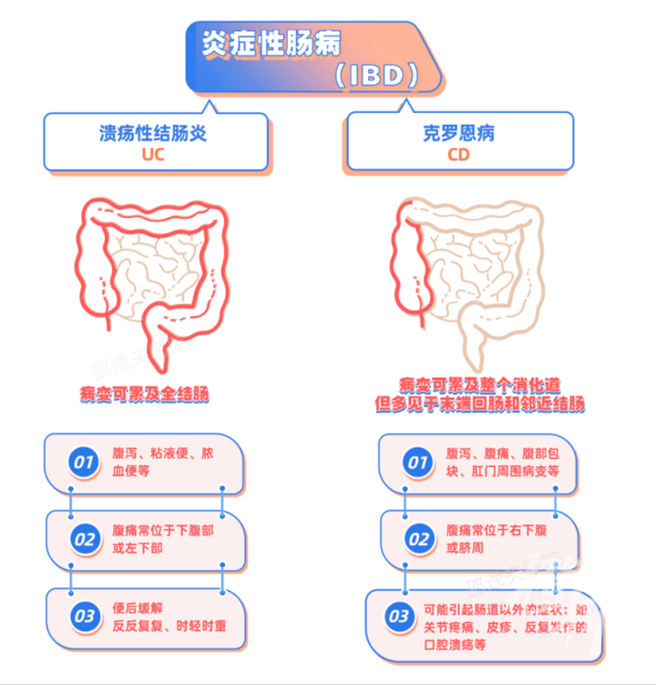 潰瘍性結(jié)腸炎與克羅恩病的區(qū)別，潰瘍性結(jié)腸炎與克羅恩病的差異解析